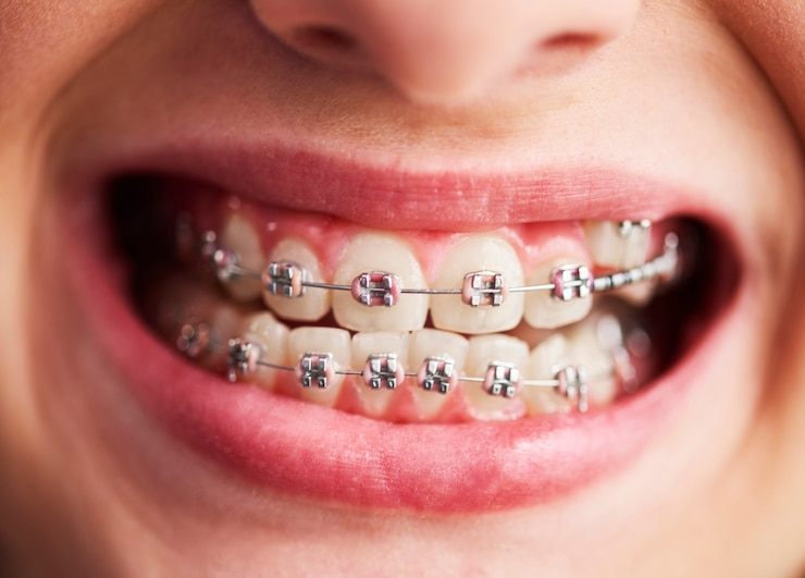Best orthodontic braces treatment in Ghaziabad