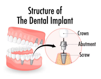 Best Dental Implants clinic in Sahibabad