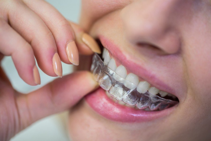 The Pros and Cons of Invisalign vs. Traditional Braces